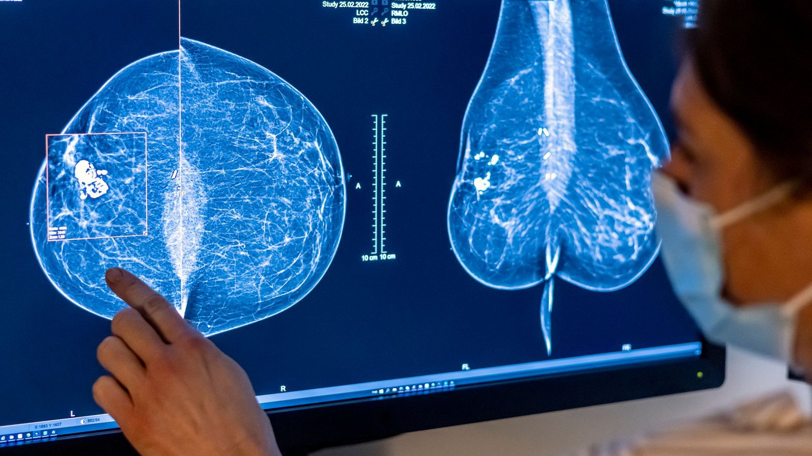 Für Frauen gibt es eine spezielle Untersuchung, um Krebs früh zu entdecken: die Mammografie. (Archivbild)Foto: Hannibal Hanschke/dpa