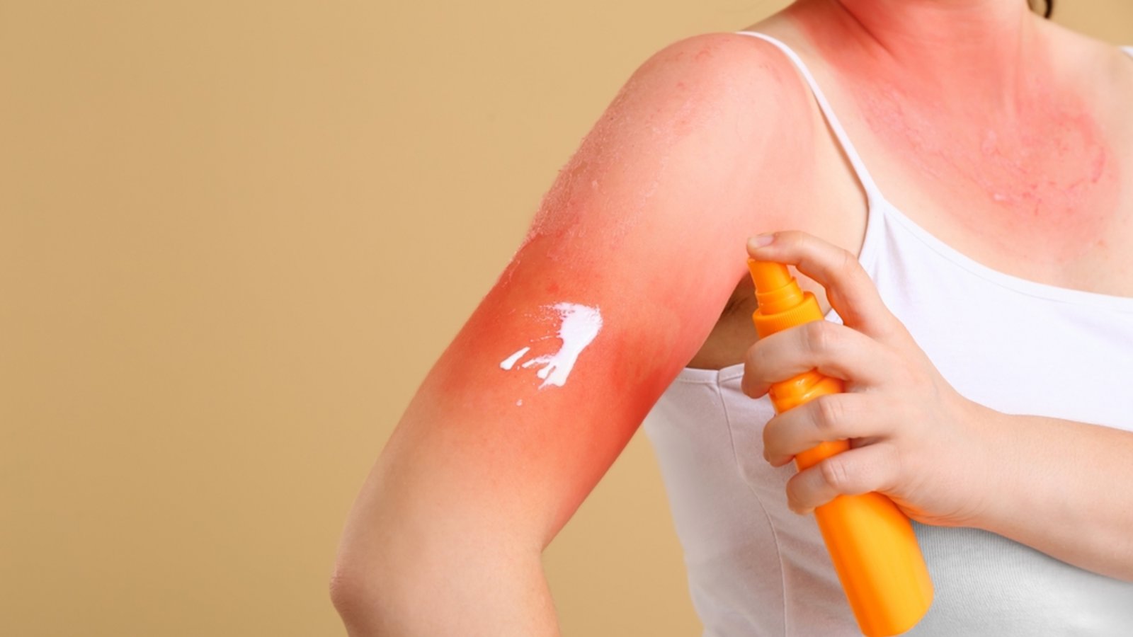 Der Sonnenbrand kann unterschiedliche Gründe haben.Foto: Pixel-Shot / shutterstock.com Der Sonnenbrand kann unterschiedliche Gründe haben.Foto: Pixel-Shot / shutterstock.com