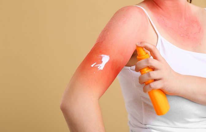 Der Sonnenbrand kann unterschiedliche Gründe haben.<span class='image-autor'>Foto: Pixel-Shot / shutterstock.com</span>