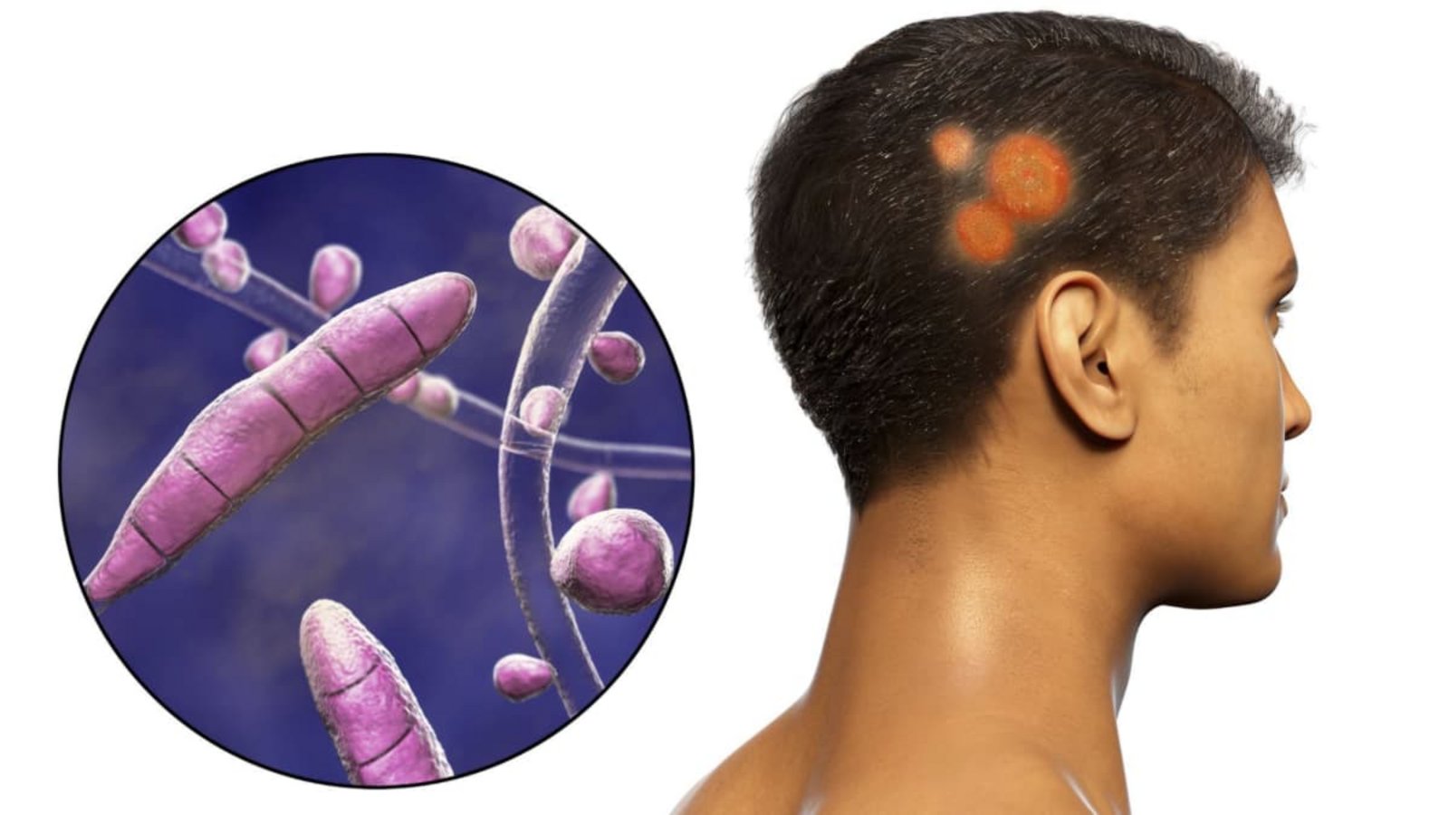 Spezielle Pilze, sogenannte Dermatophyten,  können Hautpilzerkrankung hervorrufen. Ist der Kopf betroffen, ist der Pilz Tinea capitis der Auslöser.Imago/Science Photo Library