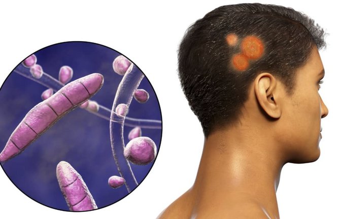 Spezielle Pilze, sogenannte Dermatophyten,  können Hautpilzerkrankung hervorrufen. Ist der Kopf betroffen, ist der Pilz Tinea capitis der Auslöser.<span class='image-autor'>Imago/Science Photo Library</span>