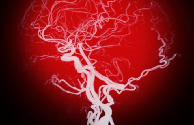 Ein Aneurysma ist eine mit Blut gefüllte sackartige Ausstülpung einer Arterie, die plötzlich aufreißen kann. Die meisten Aussackungen bilden sich an der Hauptschlagader (Aorta), der Herzwand oder im Gehirn<span class='image-autor'>Foto: Imag/Pond5 Images</span>