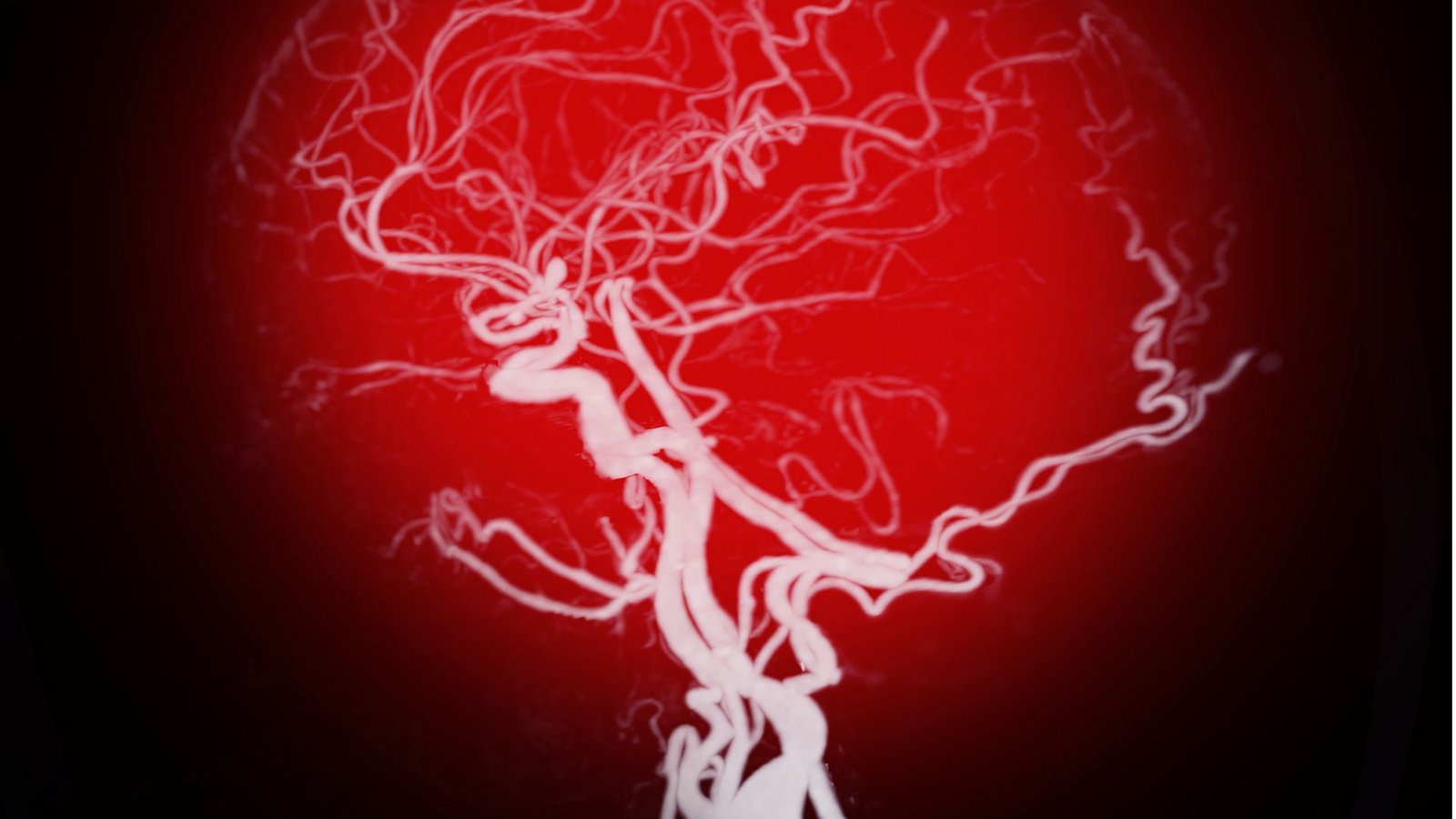 Ein Aneurysma ist eine mit Blut gefüllte sackartige Ausstülpung einer Arterie, die plötzlich aufreißen kann. Die meisten Aussackungen bilden sich an der Hauptschlagader (Aorta), der Herzwand oder im GehirnFoto: Imag/Pond5 Images Ein Aneurysma ist eine mit Blut gefüllte sackartige Ausstülpung einer Arterie, die plötzlich aufreißen kann. Die meisten Aussackungen bilden sich an der Hauptschlagader (Aorta), der Herzwand oder im GehirnFoto: Imag/Pond5 Images