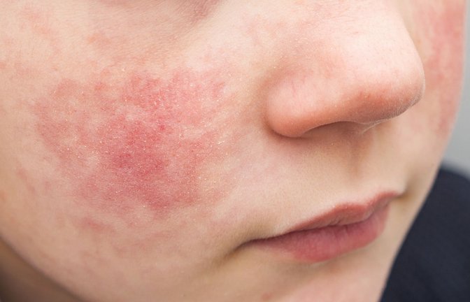 Knapp zwei Wochen nach einer Ansteckung bilden sich bei Kindern mit Ringelröteln großfleckige Rötungen auf beiden Wangen<span class='image-autor'>Foto: stock.adobe.com/Evgen</span>