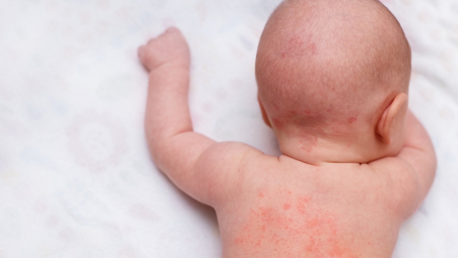 Miliaria/Hitzepickel beim Baby.Foto: Aisylu Ahmadieva/Shutterstock