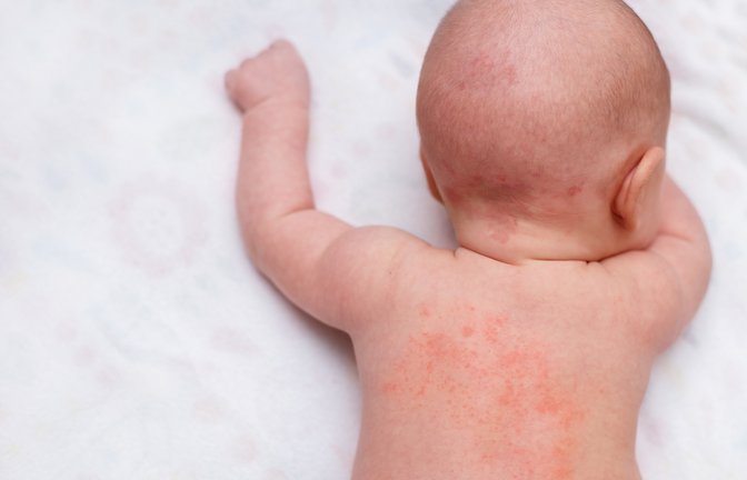 Miliaria/Hitzepickel beim Baby.<span class='image-autor'>Foto: Aisylu Ahmadieva/Shutterstock</span>