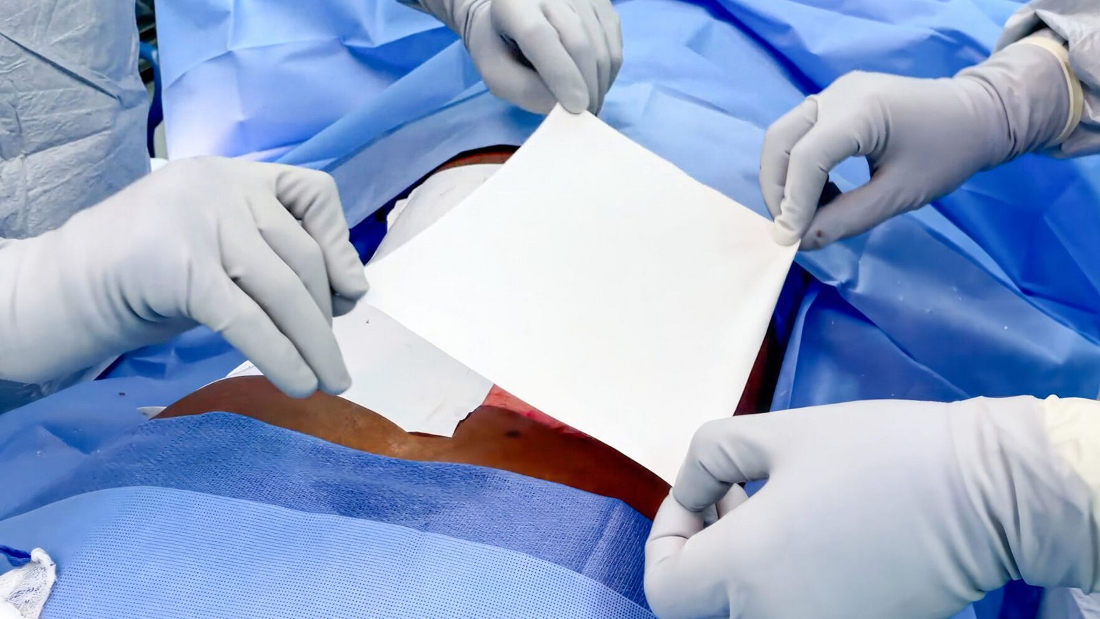 Die Ersatzhaut ist eine papierähnliche Membran, die auf Verbrennungswunden zweiten Grades aufgelegt werden kann, bis das Gewebe verheilt ist.Foto: PMI Polymedics Inovations GmbH Die Ersatzhaut ist eine papierähnliche Membran, die auf Verbrennungswunden zweiten Grades aufgelegt werden kann, bis das Gewebe verheilt ist.Foto: PMI Polymedics Inovations GmbH