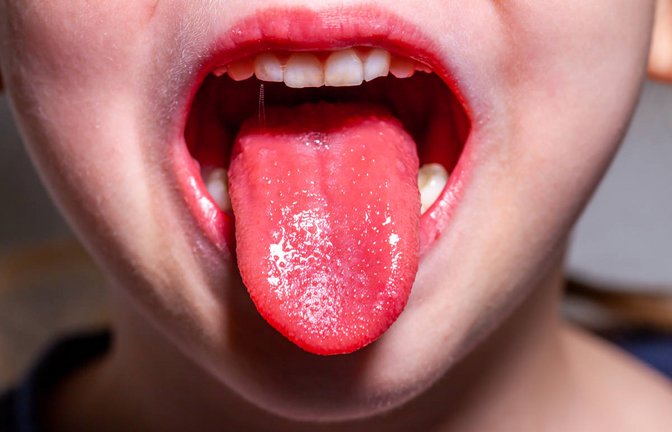 Scharlach ist eine Sonderform der Streptokokken-Angina. Ob und wann man Scharlach mehrmals bekommen kann, erfahren Sie hier.<span class='image-autor'>Foto: Lukassek / Shutterstock.com</span>