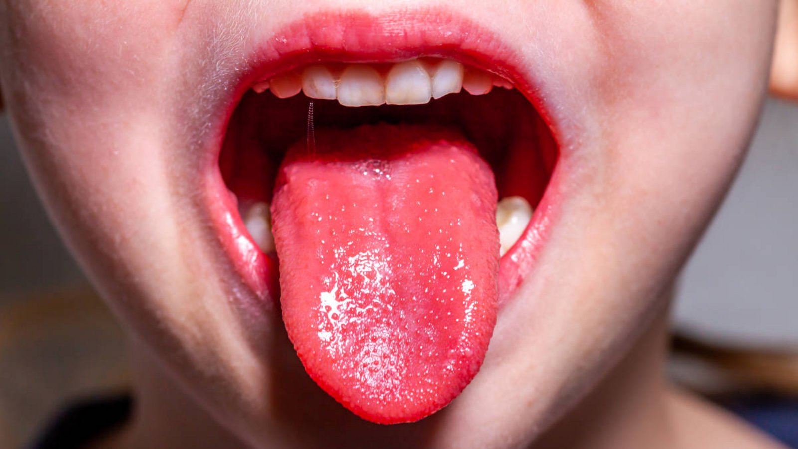 Scharlach ist eine Sonderform der Streptokokken-Angina. Ob und wann man Scharlach mehrmals bekommen kann, erfahren Sie hier.Foto: Lukassek / Shutterstock.com Scharlach ist eine Sonderform der Streptokokken-Angina. Ob und wann man Scharlach mehrmals bekommen kann, erfahren Sie hier.Foto: Lukassek / Shutterstock.com