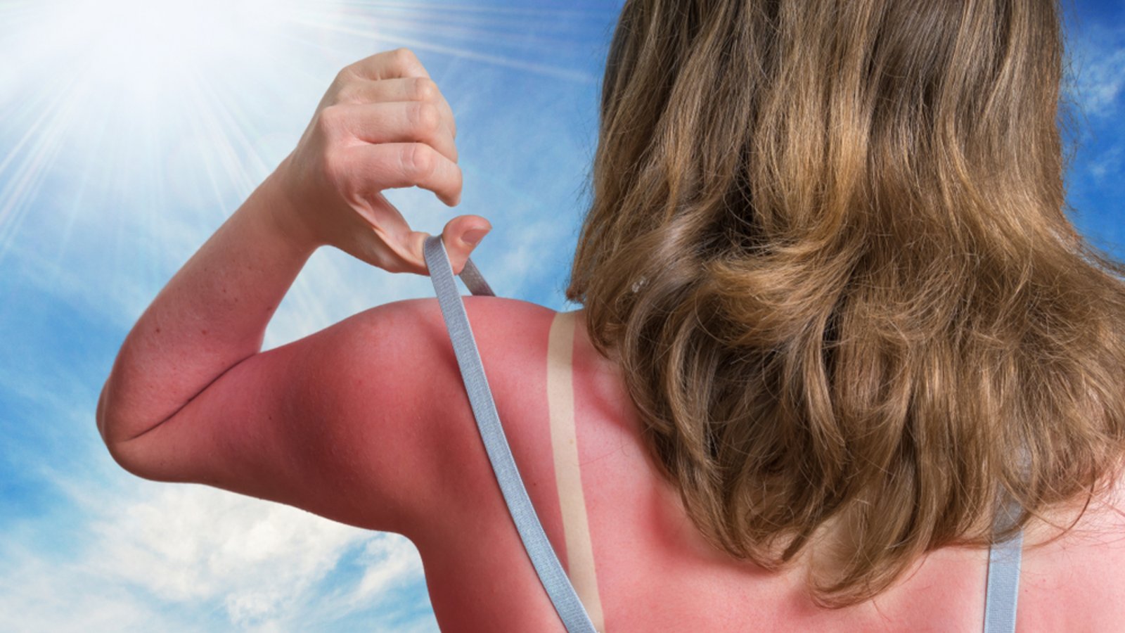 Schmerzhaft und unangenehm: Ein Sonnenbrand.Foto: vchal / shutterstock.com