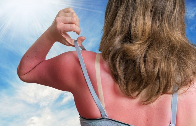 Schmerzhaft und unangenehm: Ein Sonnenbrand.<span class='image-autor'>Foto: vchal / shutterstock.com</span>