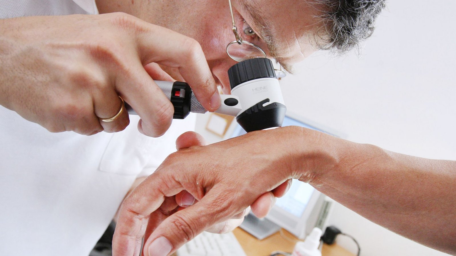 Die Zahl der Hautkrebs-Diagnosen ist in Baden-Württemberg deutlich gestiegen.Foto: picture alliance/dpa/Karl-Josef Hildenbrand Die Zahl der Hautkrebs-Diagnosen ist in Baden-Württemberg deutlich gestiegen.Foto: picture alliance/dpa/Karl-Josef Hildenbrand