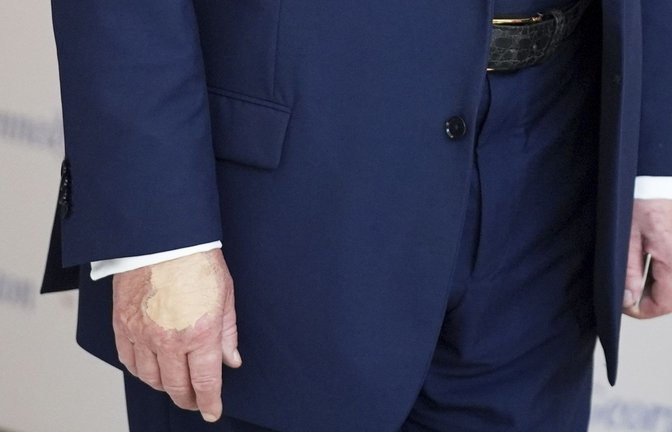 Wirklich nur vom vielen Händeschütteln? Auffällige Flecken auf Trumps Händen sorgen für Fragen.<span class='image-autor'>Foto: Evan Vucci/AP/dpa</span>