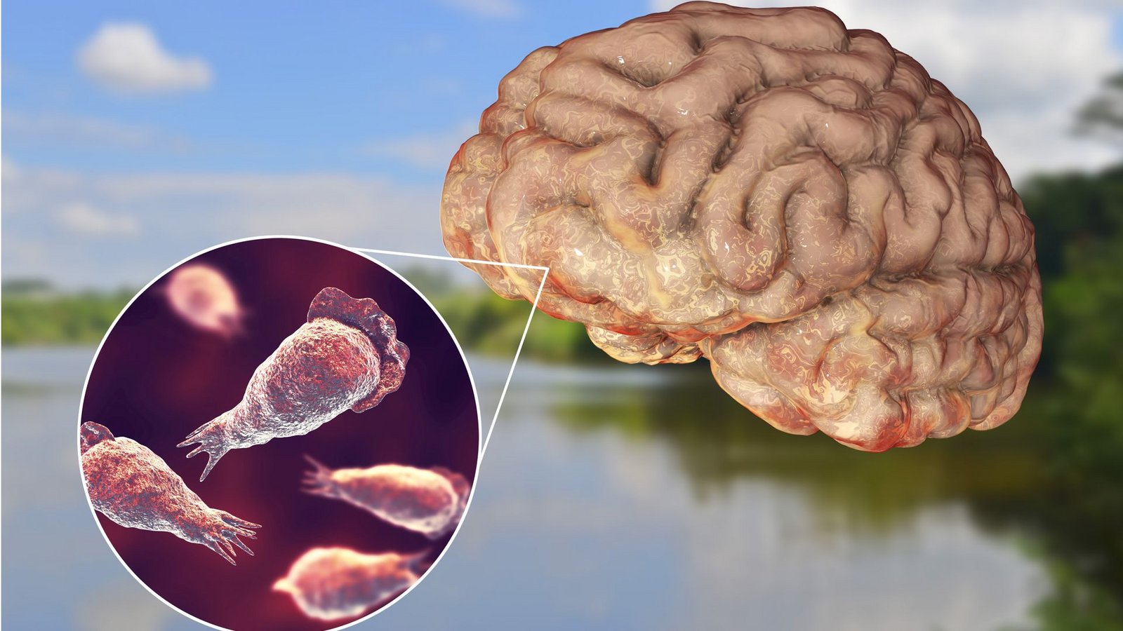 Wenn die Parasiten etwa beim Schwimmen in die Nase eines Menschen gelangen, können sie entlang des Riechnervs ins Gehirn vordringen und dort eine eitrige Hirnhautentzündung hervorrufen.Foto: Imago/Dreamstime