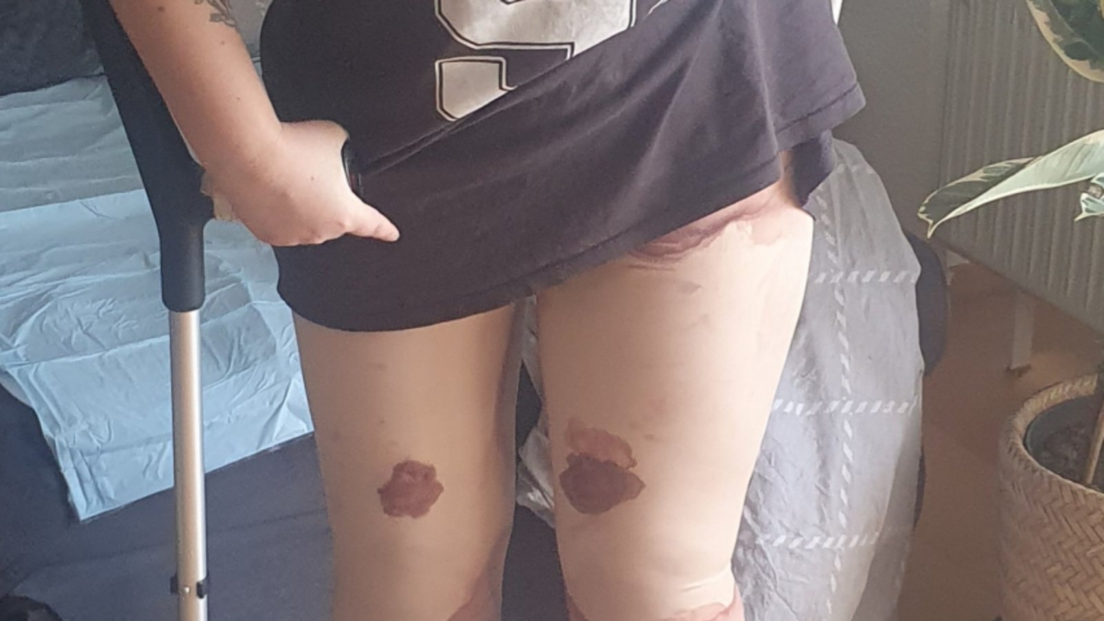 Wundflüssigkeit tritt nach der OP aus. Wundflüssigkeit tritt nach der OP aus.