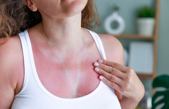 Neben Fieber und einem Kältegefühl kann es bei Sonnenbrand auch zu einem Juckreiz kommen. Hier erfahren Sie, warum das so ist.<span class='image-autor'>Foto: Ahmet Misirligul / Shutterstock.com</span>