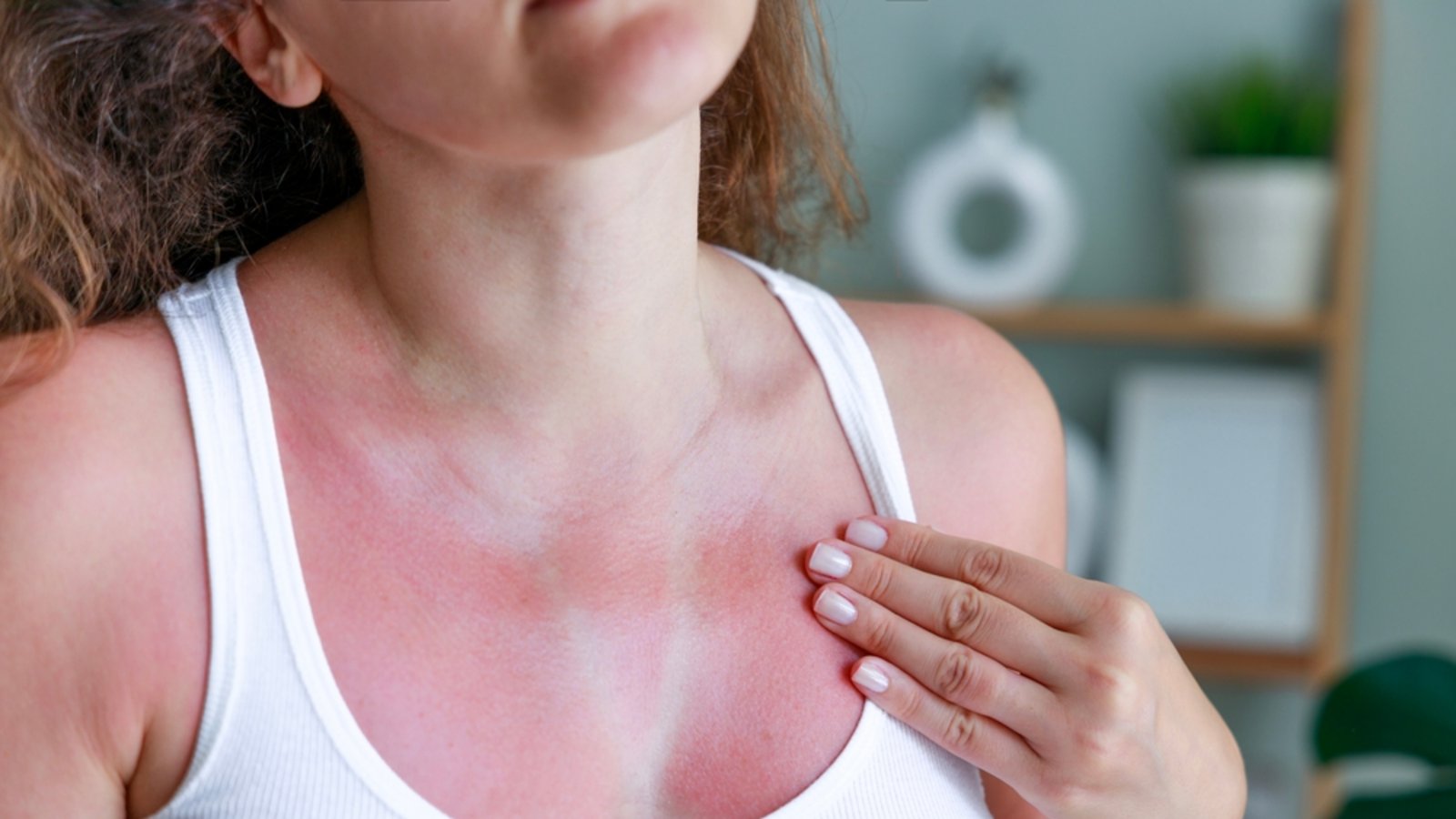 Neben Fieber und einem Kältegefühl kann es bei Sonnenbrand auch zu einem Juckreiz kommen. Hier erfahren Sie, warum das so ist.Foto: Ahmet Misirligul / Shutterstock.com