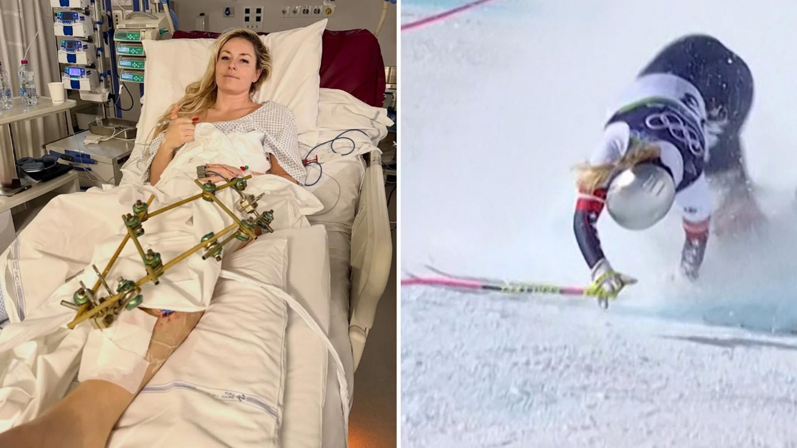 Nach ihrem Schienbeinbruch auf der Tofana liegt Lindsey Vonn mit einem „Fixateur externe“ in der Klinik.Foto: Lindsey Vonn, AFP-Handout Nach ihrem Schienbeinbruch auf der Tofana liegt Lindsey Vonn mit einem „Fixateur externe“ in der Klinik.Foto: Lindsey Vonn, AFP-Handout