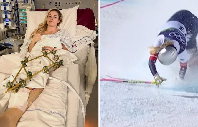 Nach ihrem Schienbeinbruch auf der Tofana liegt Lindsey Vonn mit einem „Fixateur externe“ in der Klinik.<span class='image-autor'>Foto: Lindsey Vonn, AFP-Handout</span>