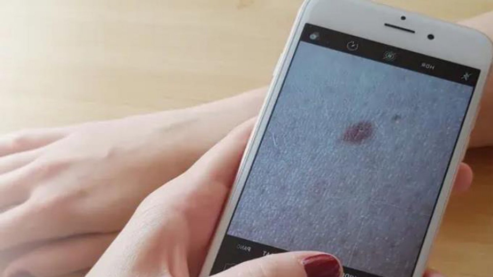 Nutzer können Bilder von Hautstellen hochladen und beurteilen lassen. Je nach Anbieter werden die Fotos mit Algorithmen oder durch Dermatologen analysiert.Foto: AppDoc Nutzer können Bilder von Hautstellen hochladen und beurteilen lassen. Je nach Anbieter werden die Fotos mit Algorithmen oder durch Dermatologen analysiert.Foto: AppDoc