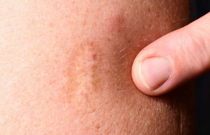 Eine Narbe einer Pockenimpfung ist an einem Oberarm sichtbar. Die Pocken galten als ausgerottet. Doch inzwischen werden aus immer mehr Ländern Nachweise und Verdachtsfälle von Affenpocken gemeldet.<span class='image-autor'>Foto: Bernd Weißbrod/dpa</span>