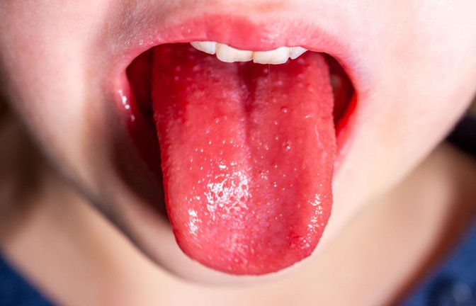 „Himbeerzunge“ – so heißt es das typische Symptom einer Scharlachinfektion im Volksmund.<span class='image-autor'>Foto: stock-adobe/Lukassek</span>
