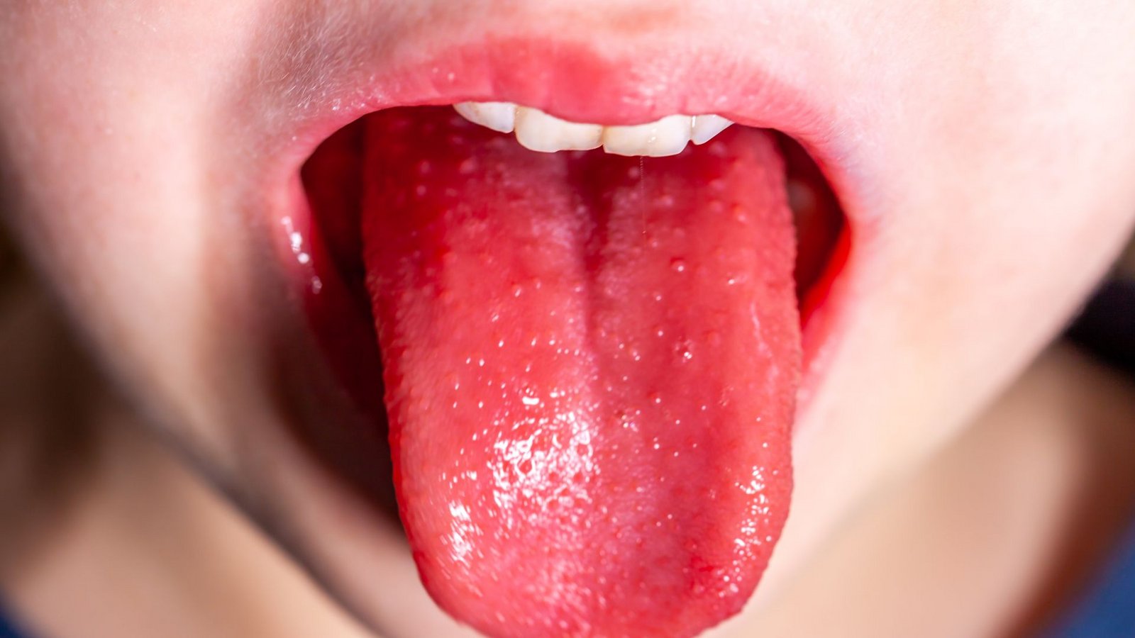 „Himbeerzunge“ – so heißt es das typische Symptom einer Scharlachinfektion im Volksmund.Foto: stock-adobe/Lukassek „Himbeerzunge“ – so heißt es das typische Symptom einer Scharlachinfektion im Volksmund.Foto: stock-adobe/Lukassek