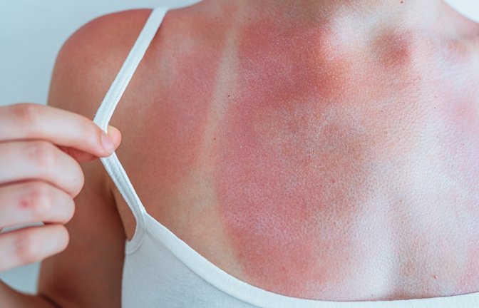 Neben Fieber kann es bei starkem Sonnenbrand auch zu Schüttelfrost kommen. Warum man bei Sonnenbrand friert, erfahren Sie hier.<span class='image-autor'>Foto: Larisa Stefanjuk / Shutterstock.com</span>