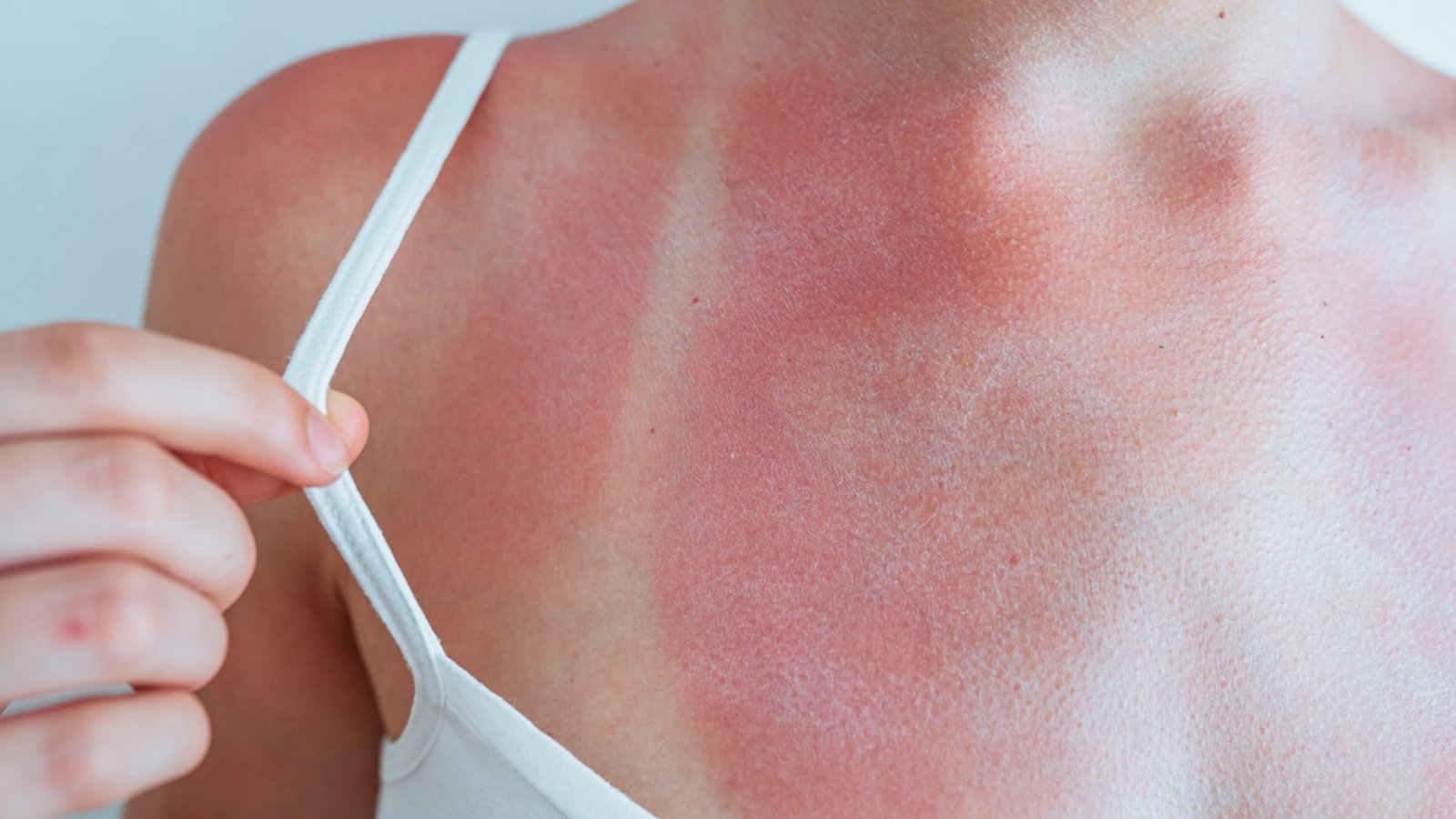 Neben Fieber kann es bei starkem Sonnenbrand auch zu Schüttelfrost kommen. Warum man bei Sonnenbrand friert, erfahren Sie hier.Foto: Larisa Stefanjuk / Shutterstock.com