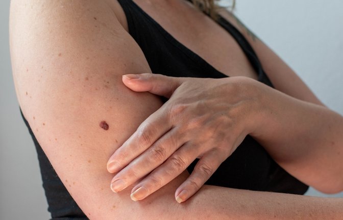Menschen mit vielen Pigmentmalen sind besonders gefährdet.<span class='image-autor'>Foto: Delovely Pics/ Shutterstock</span>