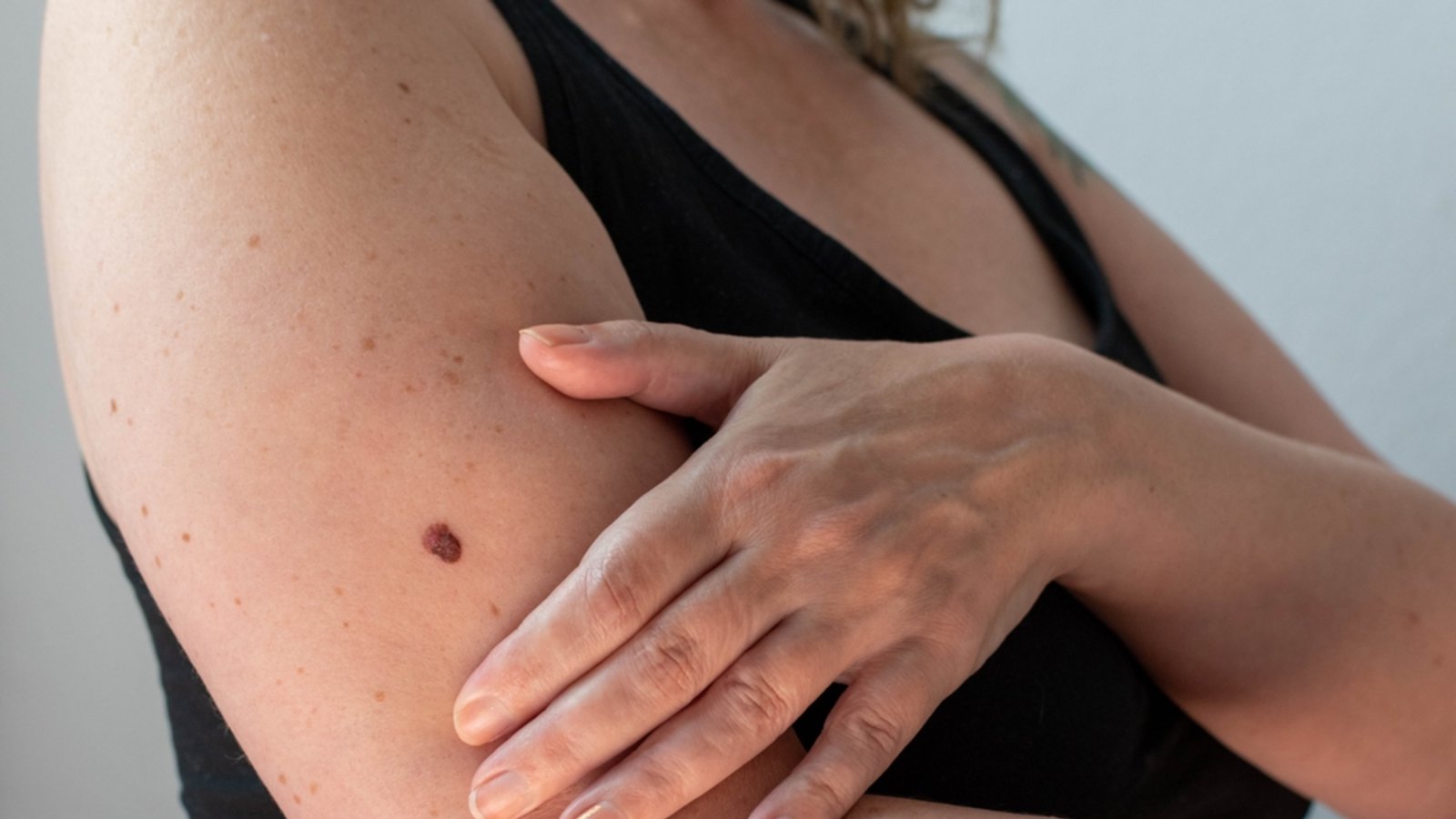 Menschen mit vielen Pigmentmalen sind besonders gefährdet.Foto: Delovely Pics/ Shutterstock Menschen mit vielen Pigmentmalen sind besonders gefährdet.Foto: Delovely Pics/ Shutterstock