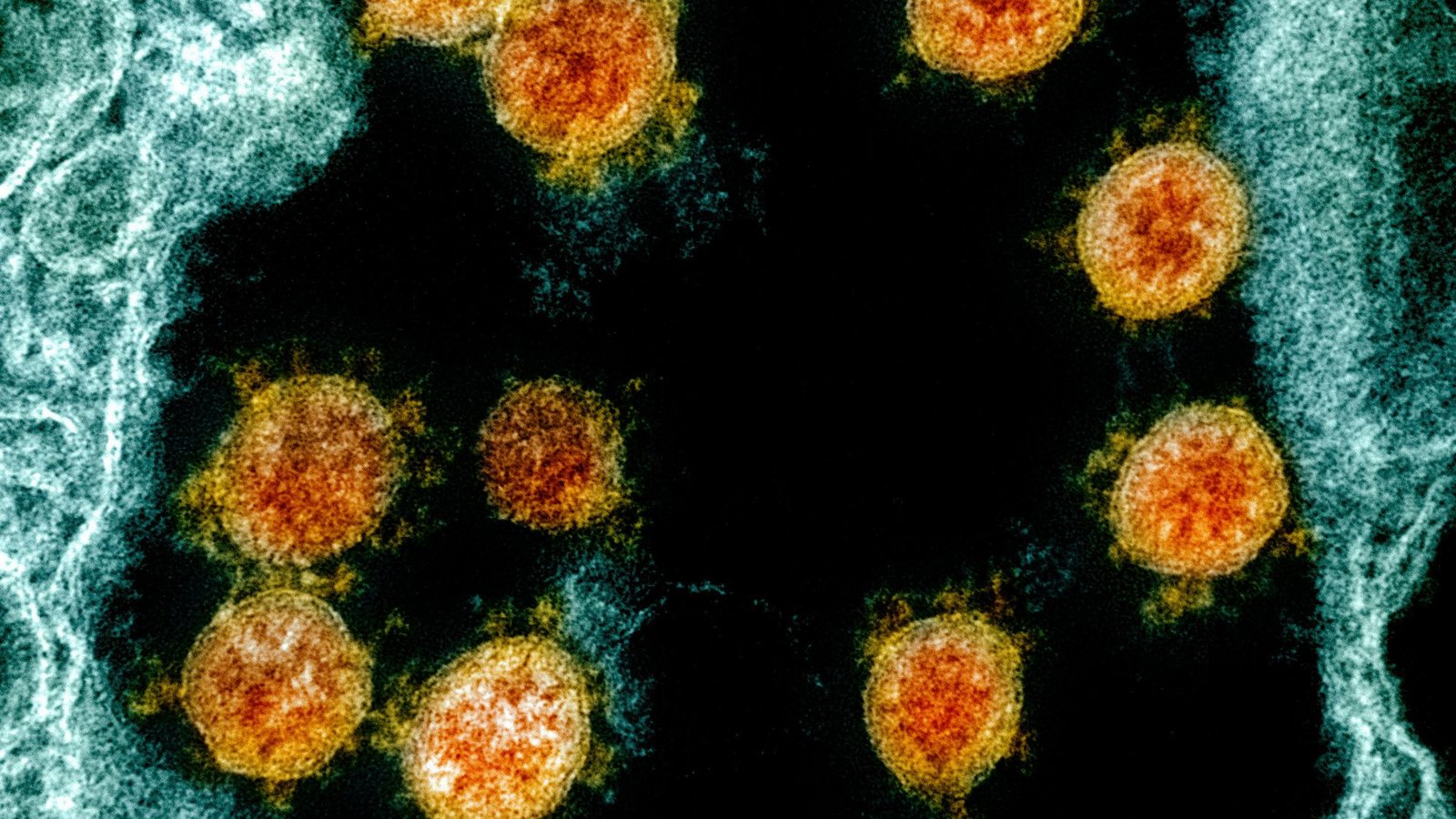Partikel des Coronavirus SARS-CoV-2 wurden für eine elektronenmikroskopische Aufnahme farblich bearbeitet.Foto: Uncredited/NIAID/NIH/dpa