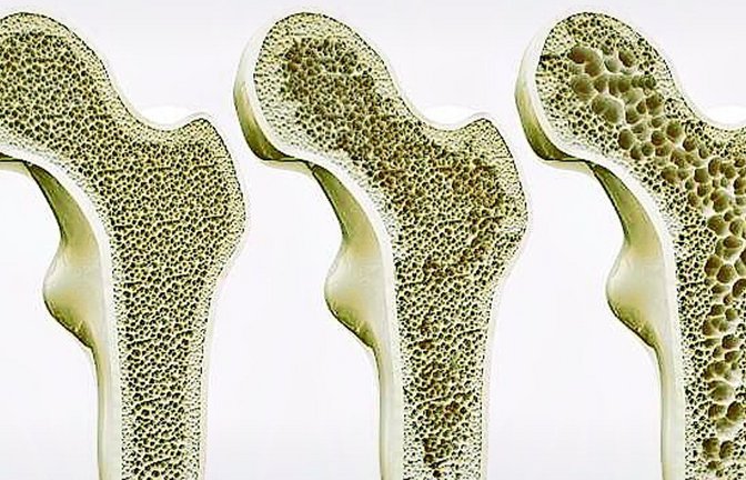 Querschnitt durch einen Knochen: Bei Osteoporose baut sich die Knochensubstanz stärker als üblich ab, der  Knochen wird dadurch brüchig.<span class='image-autor'>Foto: /Shutterstock</span>