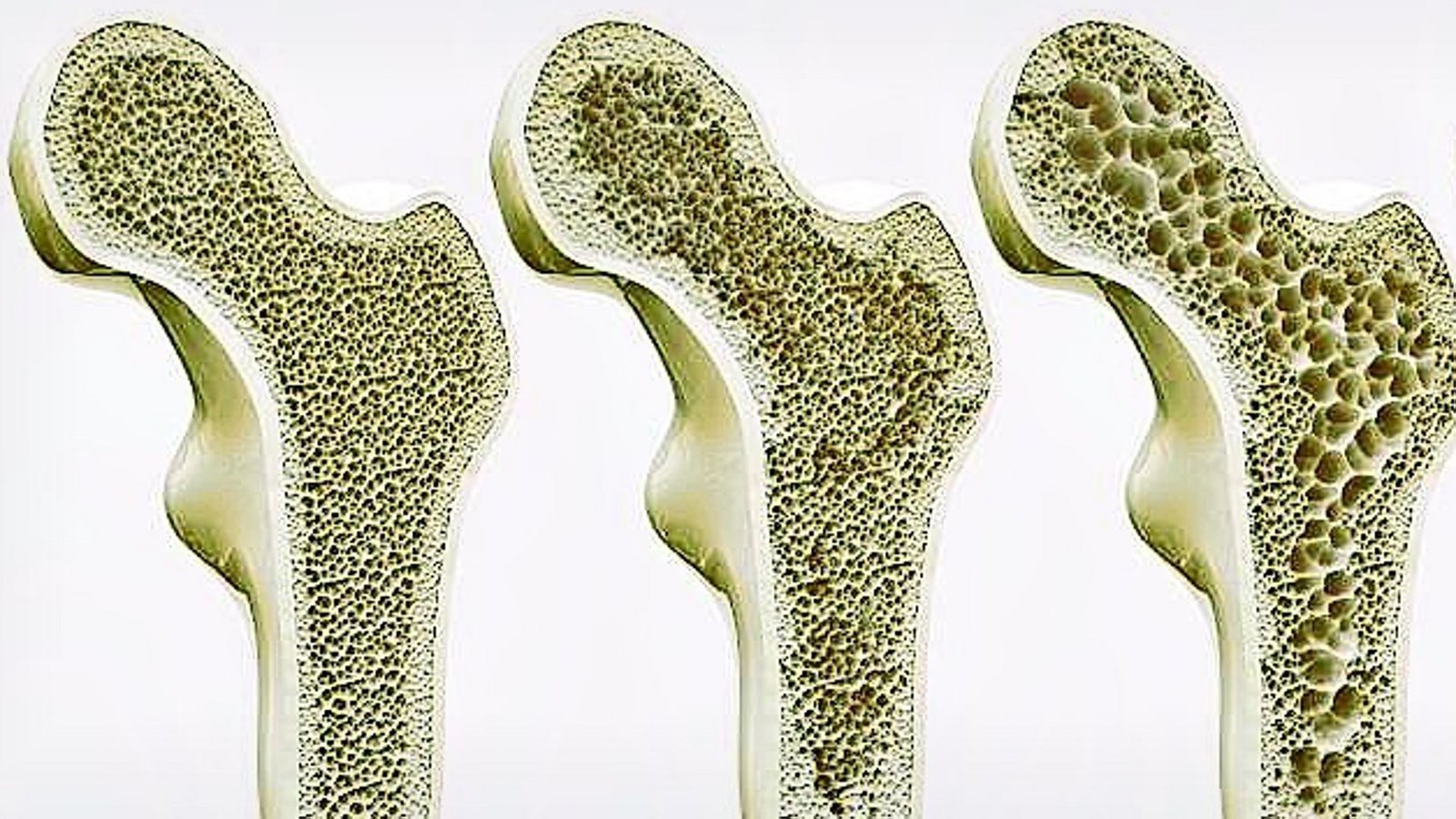 Querschnitt durch einen Knochen: Bei Osteoporose baut sich die Knochensubstanz stärker als üblich ab, der Knochen wird dadurch brüchig.Foto: /Shutterstock Querschnitt durch einen Knochen: Bei Osteoporose baut sich die Knochensubstanz stärker als üblich ab, der Knochen wird dadurch brüchig.Foto: /Shutterstock