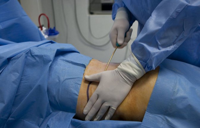 Tödliche Fettabsaugung in der Türkei (Symbolbild)<span class='image-autor'>Foto: IMAGO/BSIP</span>