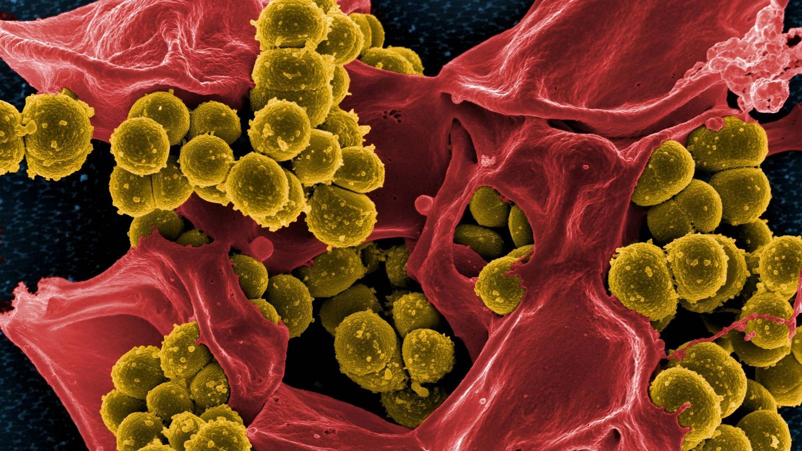 Multiresistenter Keim: Das Bakterium Staphylococcus aureus (gelb) mit zerstörte menschlichen weißes Blutzellen (rot).Foto: Imago/BSIP Multiresistenter Keim: Das Bakterium Staphylococcus aureus (gelb) mit zerstörte menschlichen weißes Blutzellen (rot).Foto: Imago/BSIP