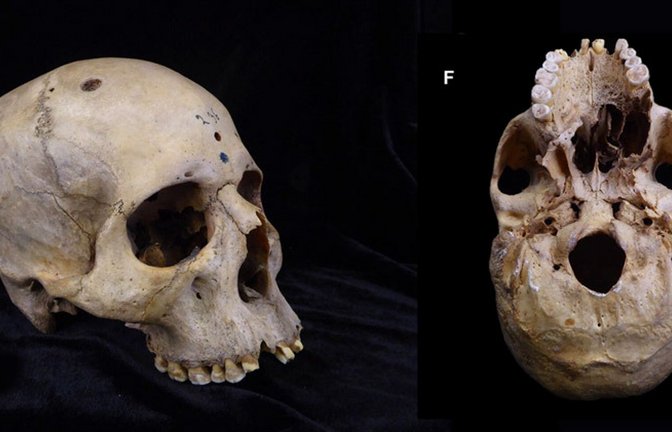 Dieser Schädel (Skull 236) eines vor rund 4300 bis 4600 Jahren lebenden Ägypters zeigt Spuren eines großen Krebsgeschwürs am Gaumen sowie Schädellöcher von Knochenmetastasen.<span class='image-autor'>Foto: © Tondini/Isidro/Camarós/2024</span>