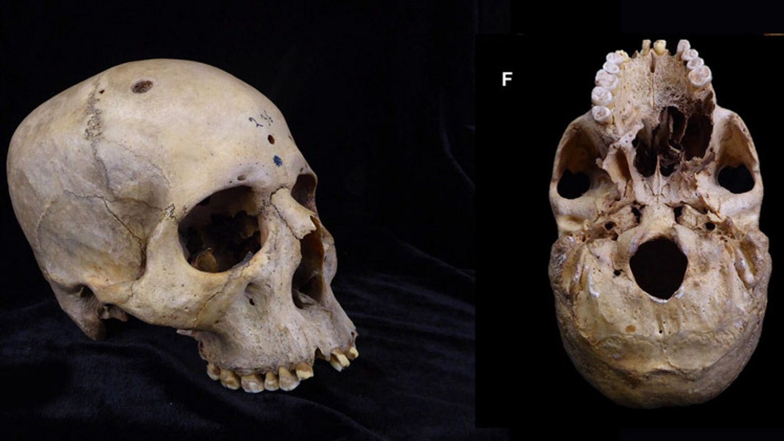 Dieser Schädel (Skull 236) eines vor rund 4300 bis 4600 Jahren lebenden Ägypters zeigt Spuren eines großen Krebsgeschwürs am Gaumen sowie Schädellöcher von Knochenmetastasen.Foto: © Tondini/Isidro/Camarós/2024 Dieser Schädel (Skull 236) eines vor rund 4300 bis 4600 Jahren lebenden Ägypters zeigt Spuren eines großen Krebsgeschwürs am Gaumen sowie Schädellöcher von Knochenmetastasen.Foto: © Tondini/Isidro/Camarós/2024