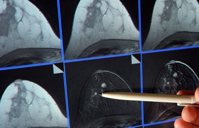 Diagnose Brustkrebs. Auch nach der Heilung bleibt es für manch eine Ex-Patientin schwierig.<span class='image-autor'>Jan-Peter Kasper/dpa</span>
