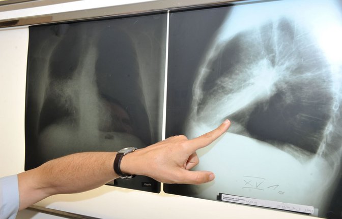Ein Arzt zeigt auf ein Röntgenbild einer von Krebs befallenen Lunge.<span class='image-autor'>Foto: Felix Hörhager/dpa/Felix Hörhager</span>