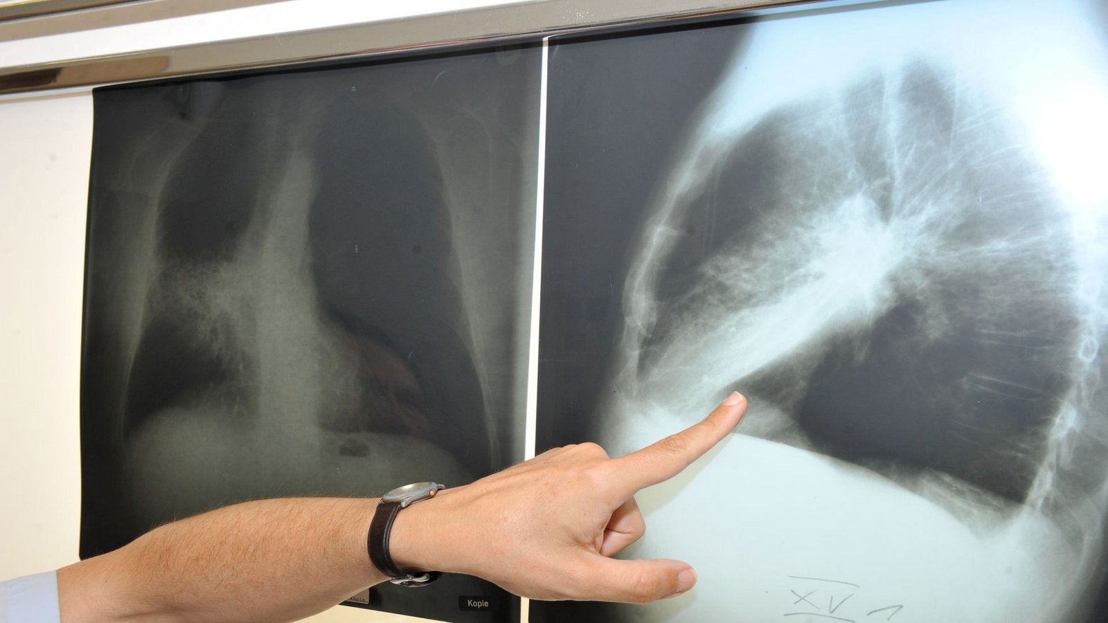 Ein Arzt zeigt auf ein Röntgenbild einer von Krebs befallenen Lunge.Foto: Felix Hörhager/dpa/Felix Hörhager Ein Arzt zeigt auf ein Röntgenbild einer von Krebs befallenen Lunge.Foto: Felix Hörhager/dpa/Felix Hörhager