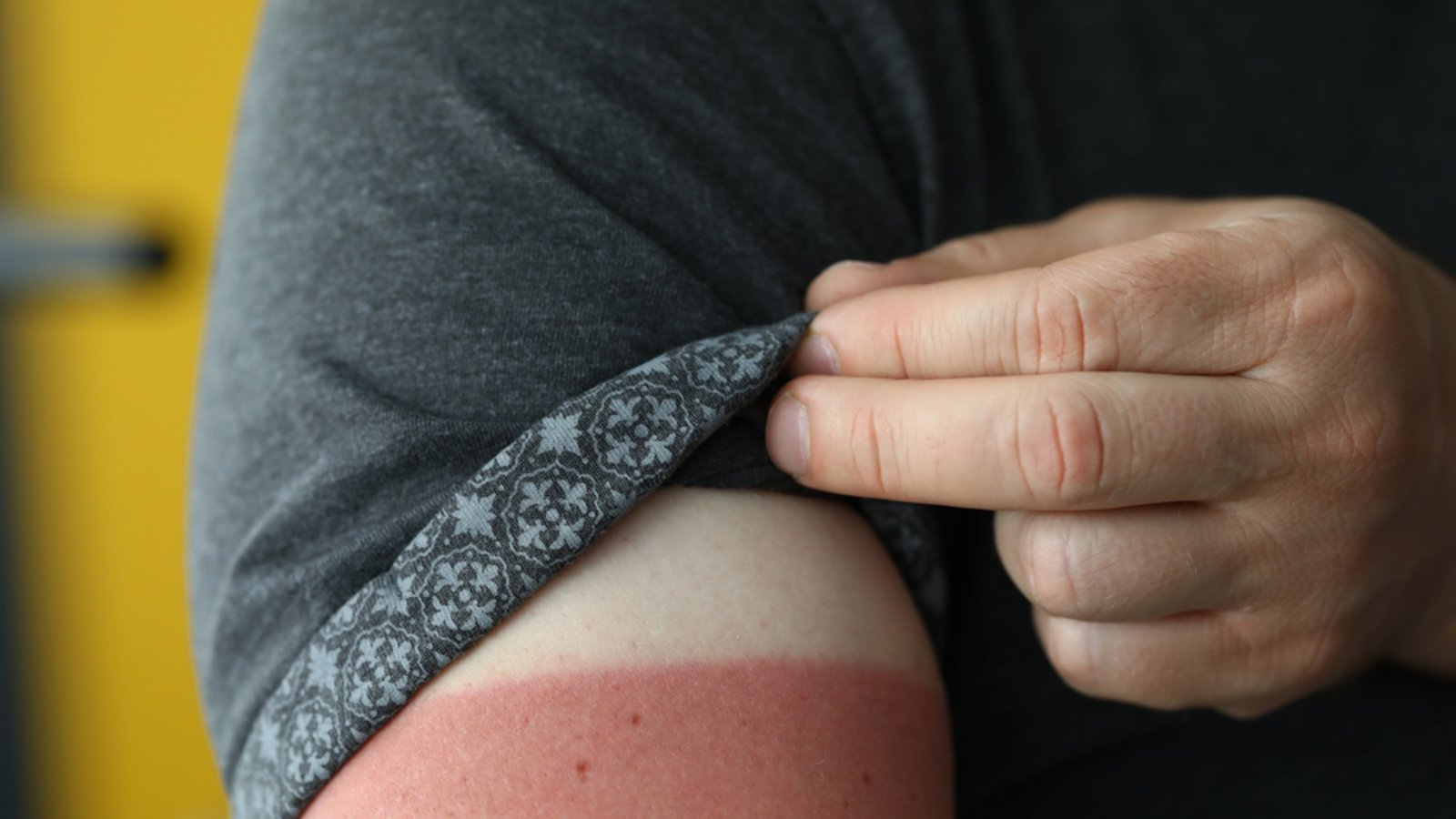 Wird der Sonnenbrand braun?Foto: ITisha / shutterstock.com Wird der Sonnenbrand braun?Foto: ITisha / shutterstock.com