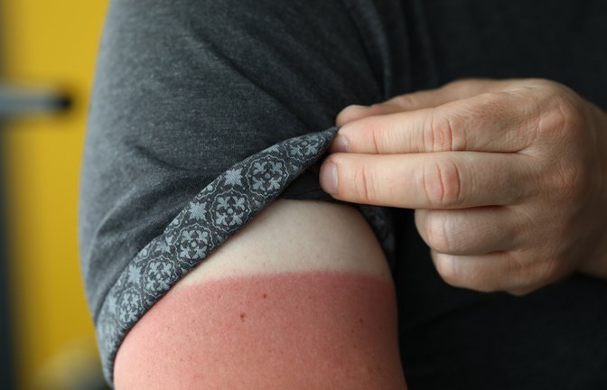 Wird der Sonnenbrand braun?<span class='image-autor'>Foto: ITisha / shutterstock.com</span>