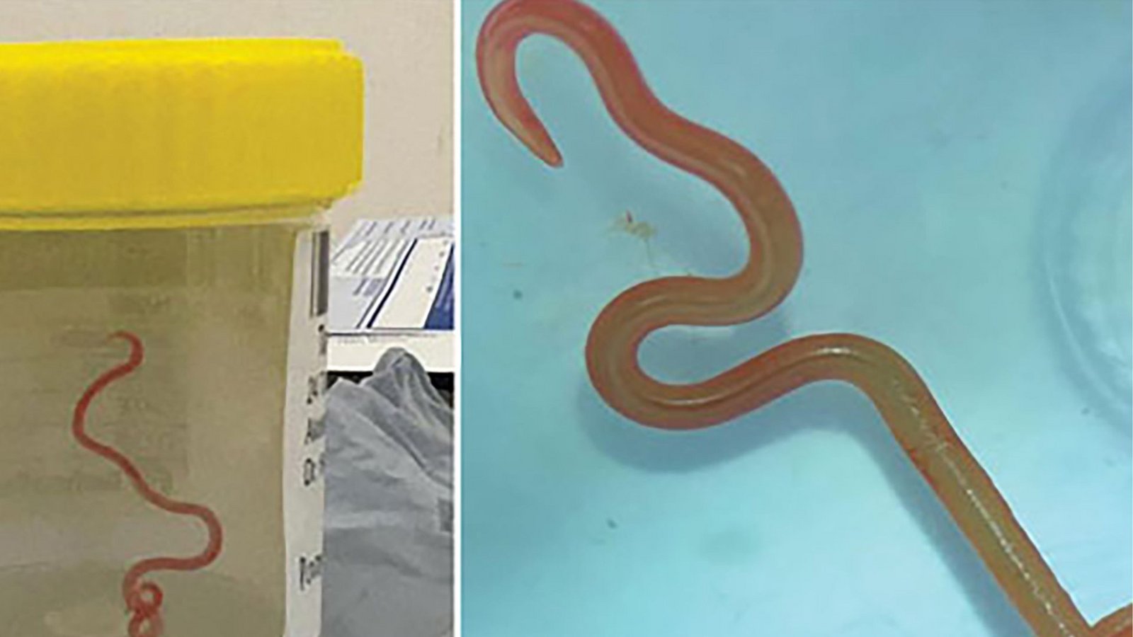 Das undatiertes Bild zeigt einen lebenden Spulwurm „Ophidascaris robertsi“, der im Gehirn einer 64-jährigen Australierin gefunden wurde. In einem Krankenhaus in Canberra haben Ärzte einen lebendigen, acht Zentimeter langen Rundwurm aus dem Gehirn einer 64-jährigen Frau entfernt.Foto: Emerging Infectious Diseases/AP/dpa Das undatiertes Bild zeigt einen lebenden Spulwurm „Ophidascaris robertsi“, der im Gehirn einer 64-jährigen Australierin gefunden wurde. In einem Krankenhaus in Canberra haben Ärzte einen lebendigen, acht Zentimeter langen Rundwurm aus dem Gehirn einer 64-jährigen Frau entfernt.Foto: Emerging Infectious Diseases/AP/dpa