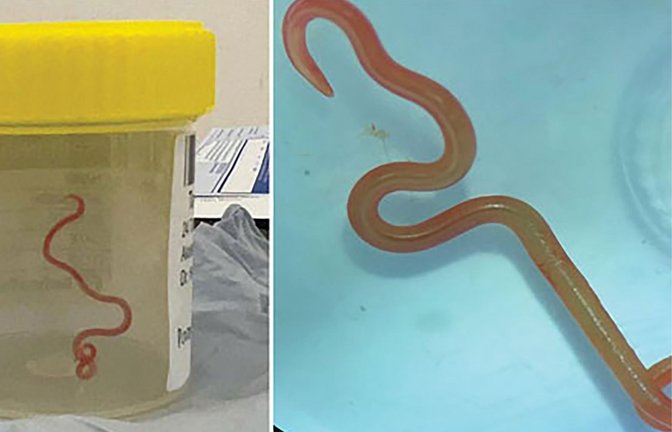 Das undatiertes Bild zeigt einen lebenden Spulwurm „Ophidascaris robertsi“, der im Gehirn einer 64-jährigen Australierin gefunden wurde. In einem Krankenhaus in Canberra haben Ärzte einen lebendigen, acht Zentimeter langen Rundwurm aus dem Gehirn einer 64-jährigen Frau entfernt.<span class='image-autor'>Foto: Emerging Infectious Diseases/AP/dpa</span>