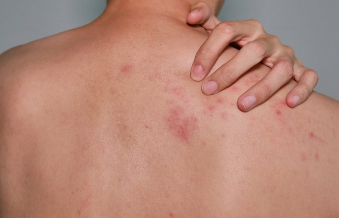 Die Gürtelrose ist eine Folgeerkrankung der Windpocken, aber wie oft kann man die Gürtelrose (Herpes-Zoster) eigentlich bekommen?<span class='image-autor'>Foto: Sakaj Pawasuttikul / Shutterstock.com</span>
