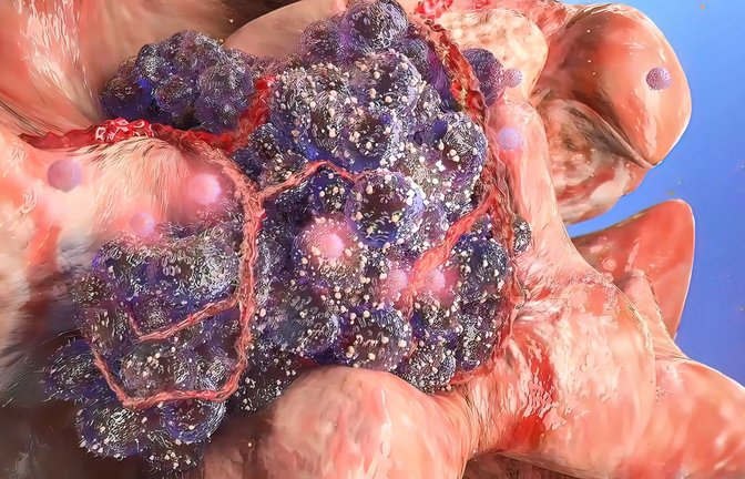 Zell-Mutation und -Entartung: Eine Krebszelle (dunkelviolett) breitet sich in gesundem Gewebe aus und befällt dieses.<span class='image-autor'>Foto: Imago/Pond5 Images</span>