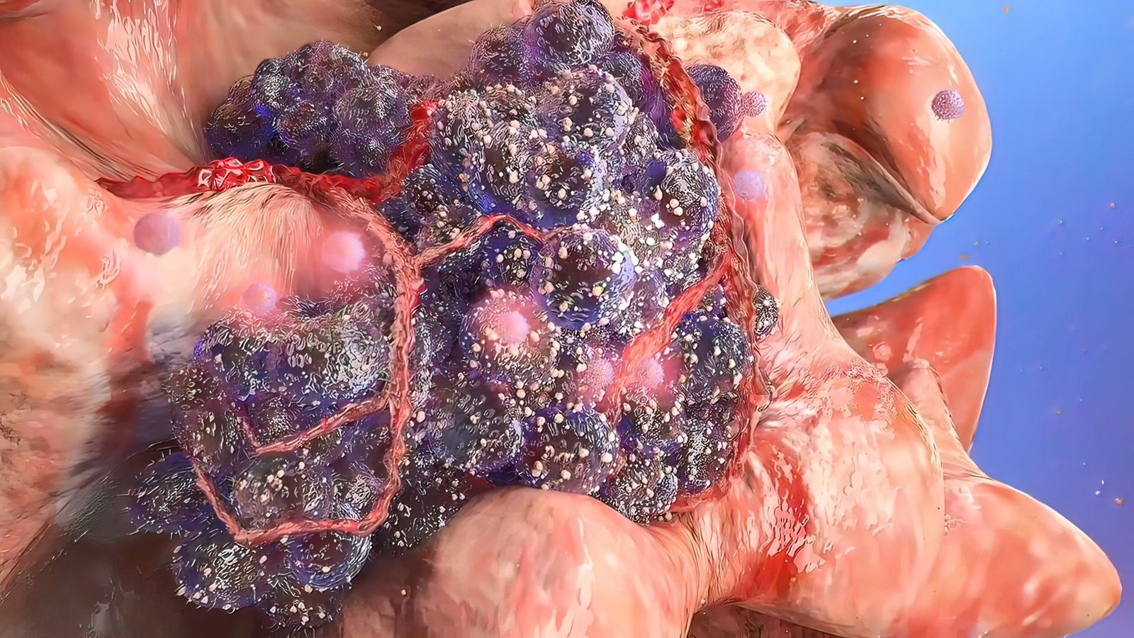 Zell-Mutation und -Entartung: Eine Krebszelle (dunkelviolett) breitet sich in gesundem Gewebe aus und befällt dieses.Foto: Imago/Pond5 Images