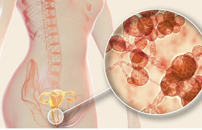 Candida auris gehört zu den Hefepilzen.  Auch Scheidenpilze zählen zu dieser Art. Eine Infektion kann schmerzhaft sein, ist im Gegensatz zu einem Befall mit Candida auris aber gut zu behandeln.<span class='image-autor'>Foto: imago/Science Photo Library</span>