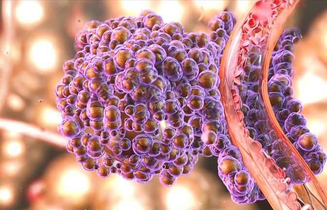 Ein Tumor streut Metastasen in verschiedene Regionen des Körpers.<span class='image-autor'>Foto: Imago/Depositphotos</span>